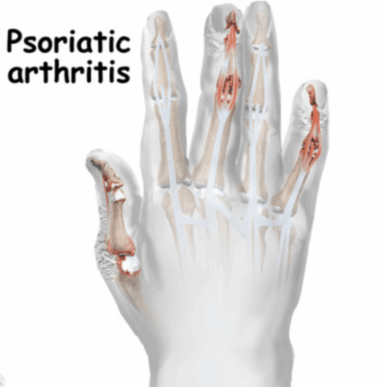 Psoriatic Arthritis