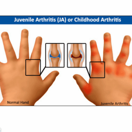 Childhood Arthritis